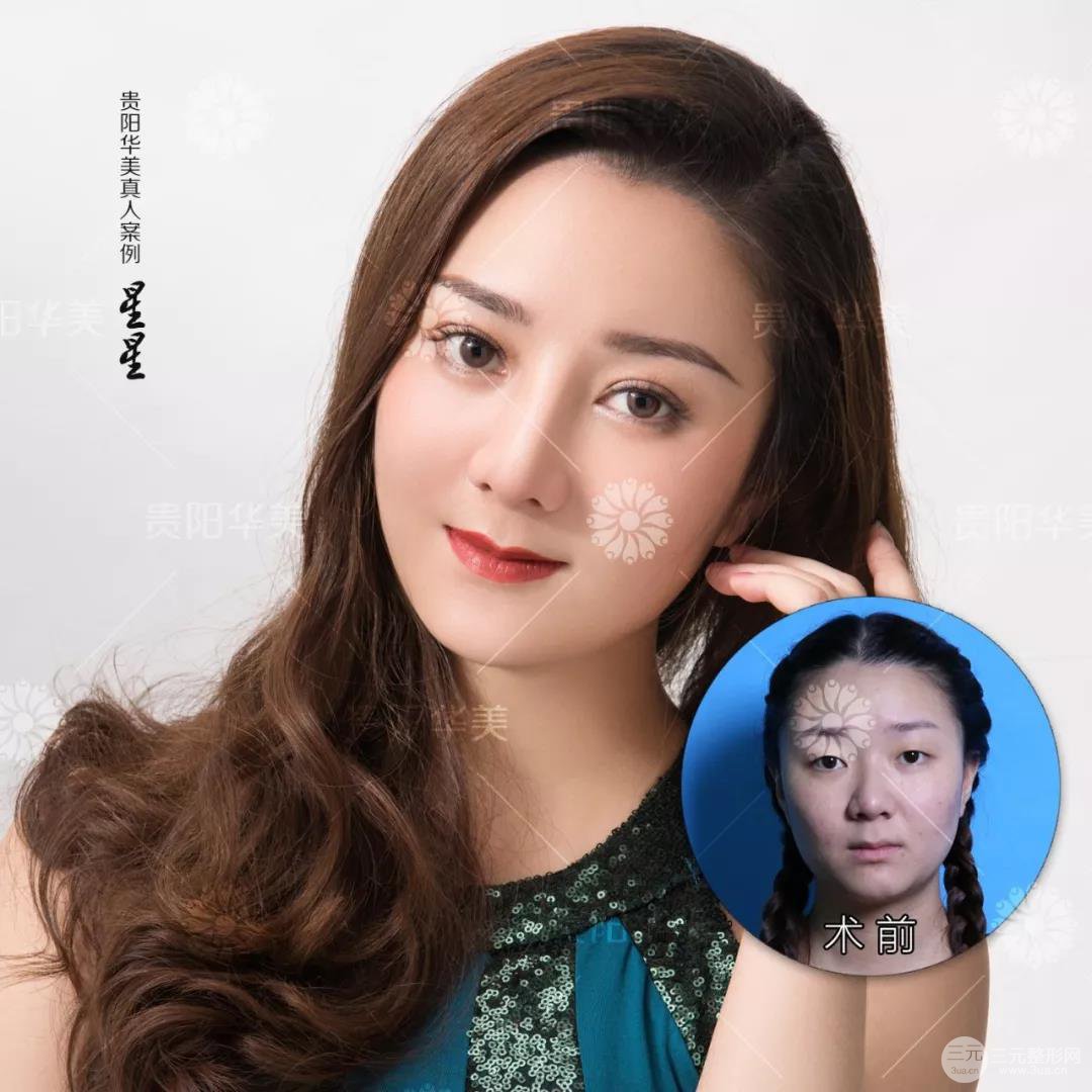 貴陽(yáng)華美郭宗科全切雙眼皮+假體隆鼻案例前后對(duì)比圖 華美員工全臉整形實(shí)錄