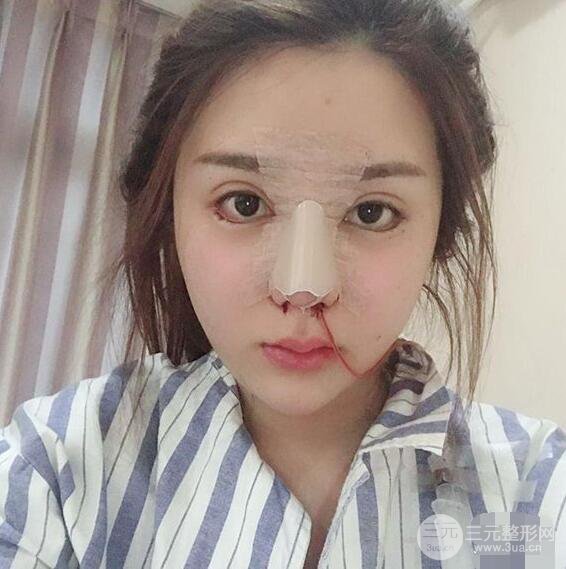 昆明吳氏嘉美李明硅膠隆鼻前后對比圖恢復心情小札