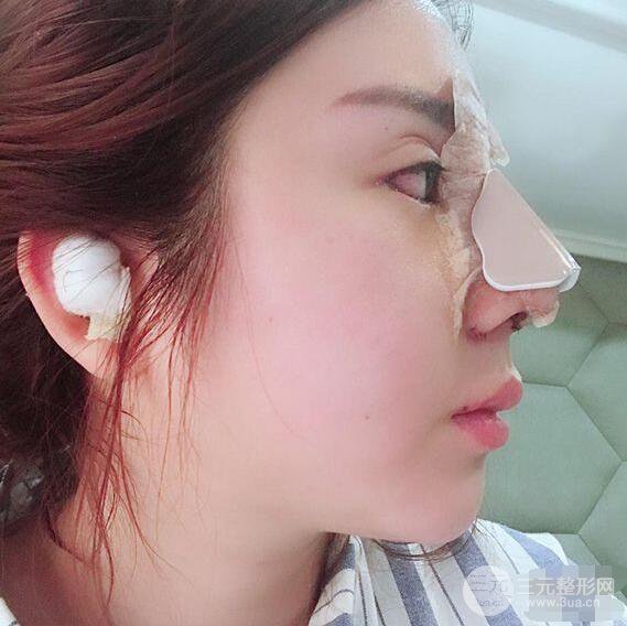 昆明吳氏嘉美李明硅膠隆鼻前后對比圖恢復心情小札