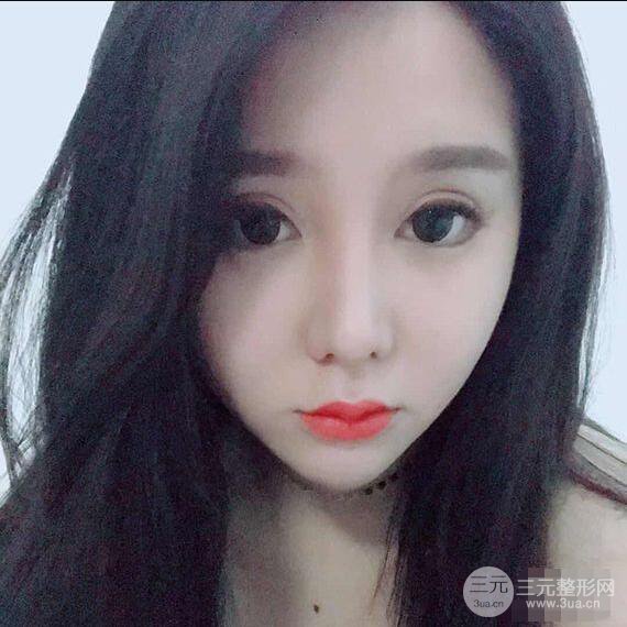 昆明吳氏嘉美李明硅膠隆鼻前后對比圖恢復心情小札