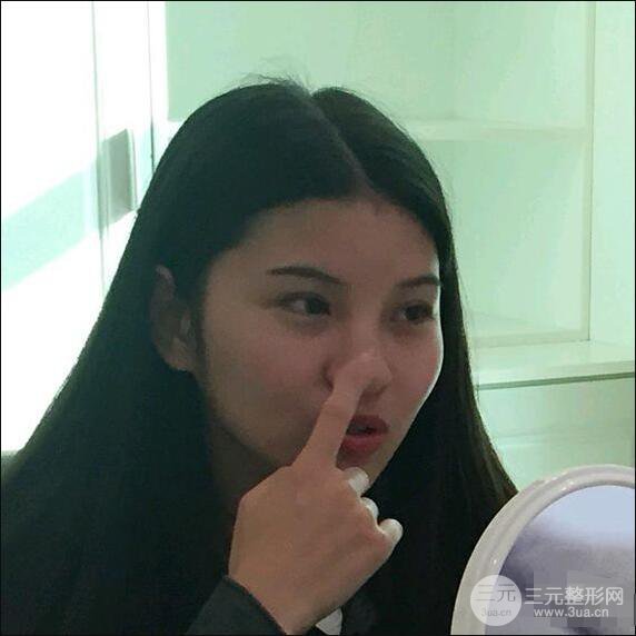 成都華西醫(yī)院整形美容科卿勇隆鼻整形前后對比圖恢復心情小札