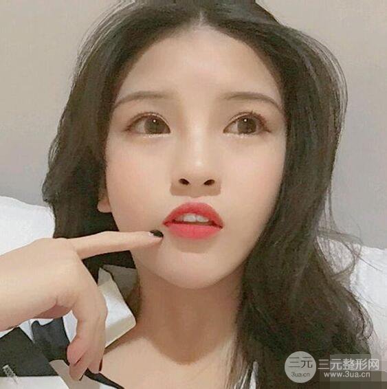 成都華西醫(yī)院整形美容科卿勇隆鼻整形前后對比圖恢復心情小札