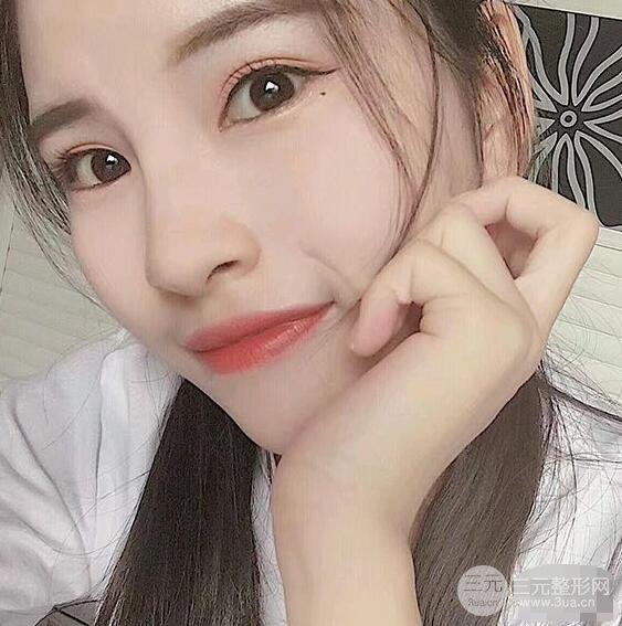 成都華西醫(yī)院整形美容科卿勇隆鼻整形前后對比圖恢復心情小札