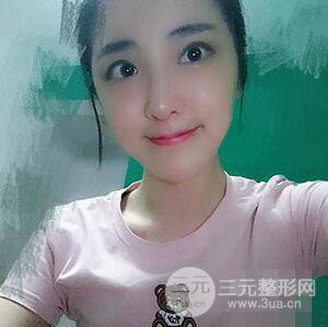 杭州格萊美張樹功假體隆鼻前后對(duì)比圖|內(nèi)附恢復(fù)心情變化哦