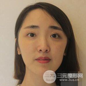 杭州格萊美張樹功假體隆鼻前后對(duì)比圖|內(nèi)附恢復(fù)心情變化哦