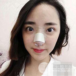 杭州格萊美張樹功假體隆鼻前后對(duì)比圖|內(nèi)附恢復(fù)心情變化哦