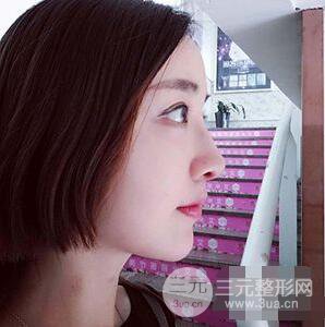 杭州格萊美張樹功假體隆鼻前后對(duì)比圖|內(nèi)附恢復(fù)心情變化哦