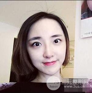 杭州格萊美張樹功假體隆鼻前后對(duì)比圖|內(nèi)附恢復(fù)心情變化哦