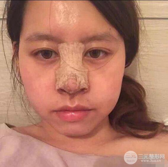 重慶華美何春濤硅膠隆鼻前后對比圖 內(nèi)附恢復(fù)心情小札
