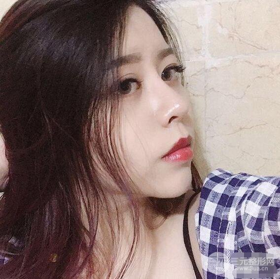 重慶華美何春濤硅膠隆鼻前后對比圖 內(nèi)附恢復(fù)心情小札