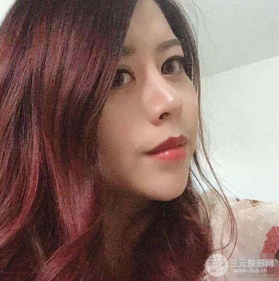 重慶華美何春濤硅膠隆鼻前后對比圖 內(nèi)附恢復(fù)心情小札