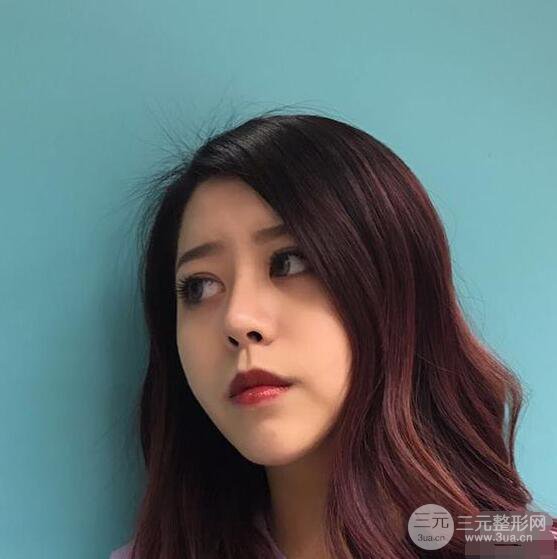 重慶華美何春濤硅膠隆鼻前后對比圖 內(nèi)附恢復(fù)心情小札