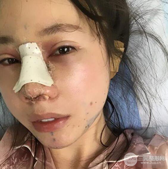 北京聯(lián)合麗格吳焱秋耳軟骨隆鼻前后對(duì)比圖|塌鼻子的救星