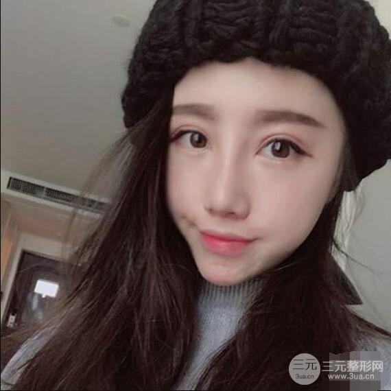 北京聯(lián)合麗格吳焱秋耳軟骨隆鼻前后對(duì)比圖|塌鼻子的救星