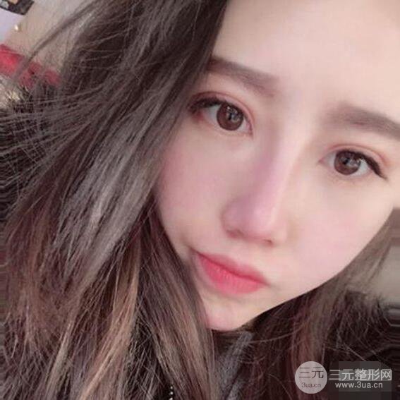 北京聯(lián)合麗格吳焱秋耳軟骨隆鼻前后對(duì)比圖|塌鼻子的救星
