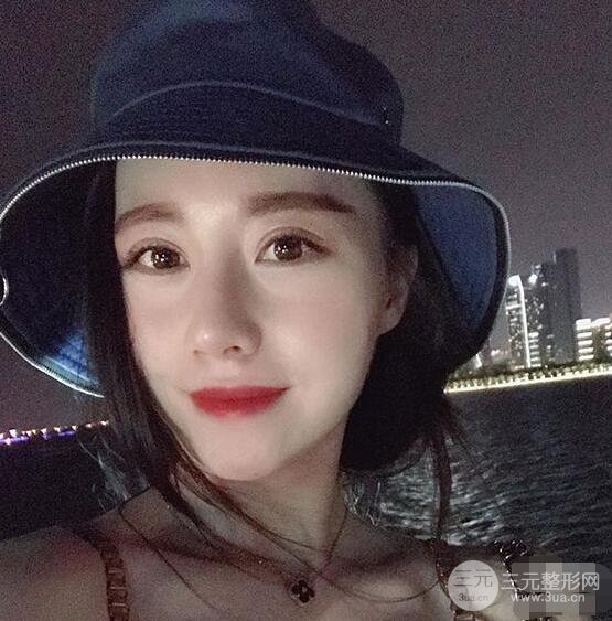 北京聯(lián)合麗格吳焱秋耳軟骨隆鼻前后對(duì)比圖|塌鼻子的救星