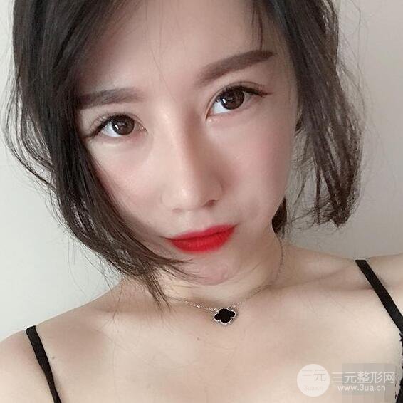 北京聯(lián)合麗格吳焱秋耳軟骨隆鼻前后對(duì)比圖|塌鼻子的救星