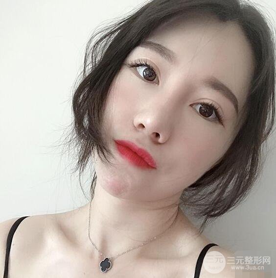 北京聯(lián)合麗格吳焱秋耳軟骨隆鼻前后對(duì)比圖|塌鼻子的救星