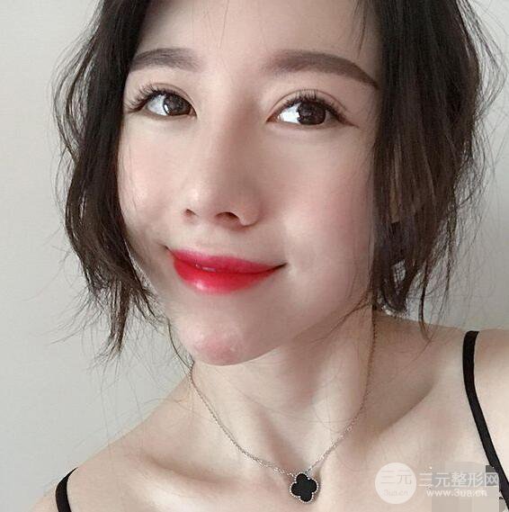 北京聯(lián)合麗格吳焱秋耳軟骨隆鼻前后對(duì)比圖|塌鼻子的救星