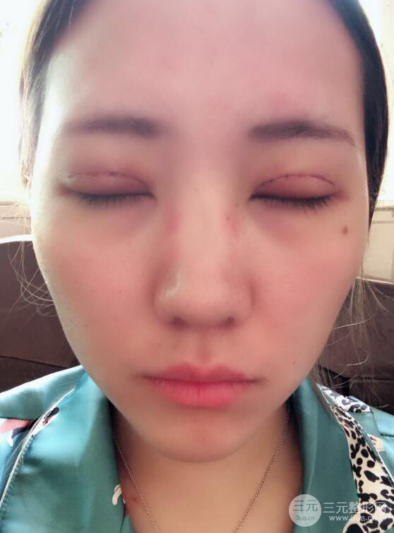 哈醫(yī)大二院整形科肖志波全切雙眼皮前后對(duì)比圖 真實(shí)恢復(fù)經(jīng)歷日記