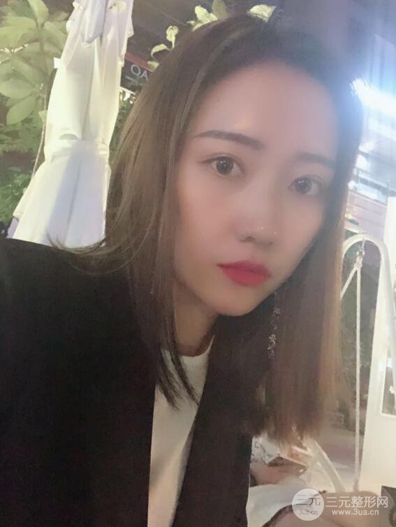 哈醫(yī)大二院整形科肖志波全切雙眼皮前后對(duì)比圖 真實(shí)恢復(fù)經(jīng)歷日記