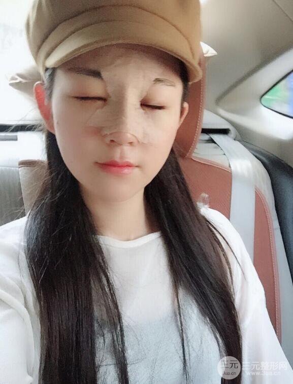 杭州華山連天美高俊明假體隆鼻術前術后對比圖 兩個月恢復心情