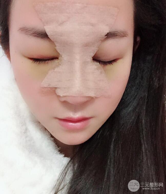 杭州華山連天美高俊明假體隆鼻術前術后對比圖 兩個月恢復心情