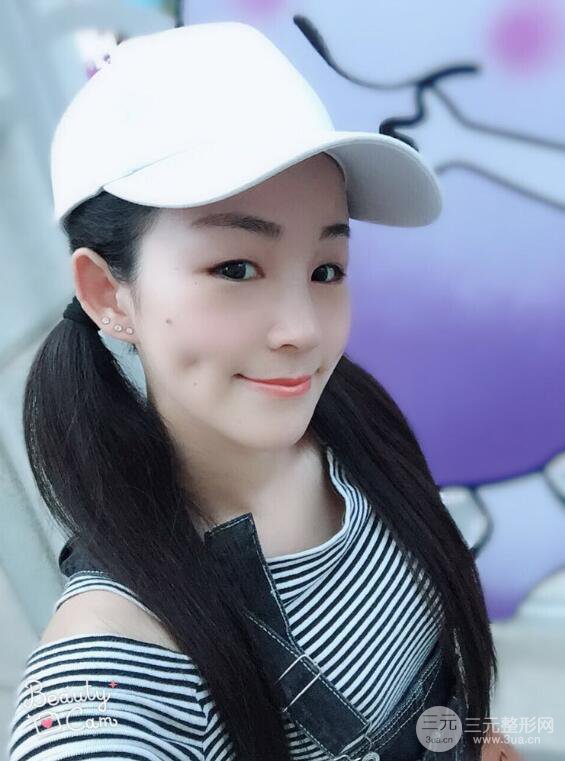 杭州華山連天美高俊明假體隆鼻術前術后對比圖 兩個月恢復心情