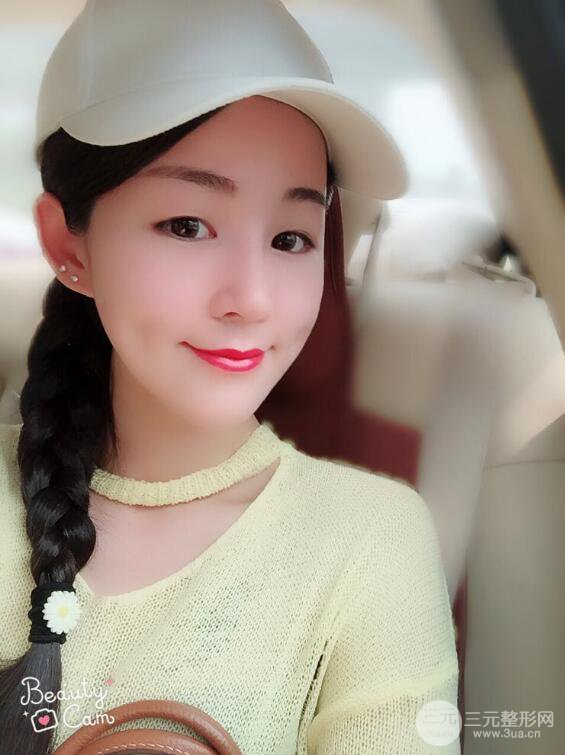 杭州華山連天美高俊明假體隆鼻術前術后對比圖 兩個月恢復心情