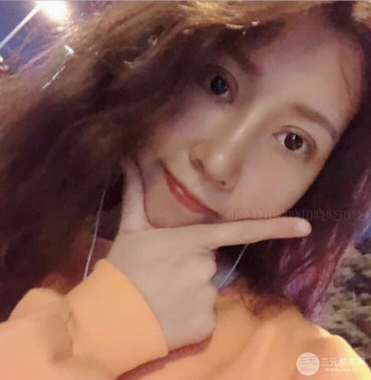 松原齊飛隆鼻整形+雙眼皮一個月前后對比圖真人案例小札