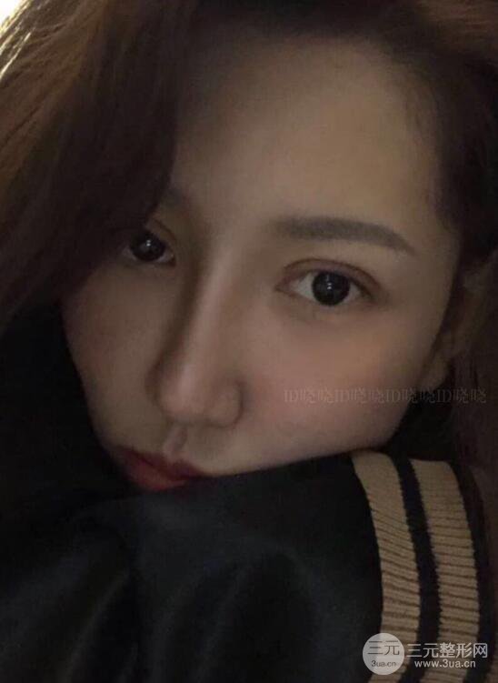 松原齊飛隆鼻整形+雙眼皮一個月前后對比圖真人案例小札