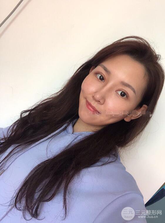 松原齊飛隆鼻整形+雙眼皮一個月前后對比圖真人案例小札