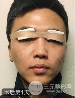 歐陽(yáng)春雙眼皮前后對(duì)比圖 男孩子割雙眼皮一樣好看