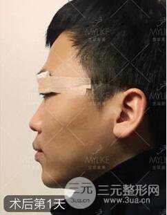 歐陽(yáng)春雙眼皮前后對(duì)比圖 男孩子割雙眼皮一樣好看