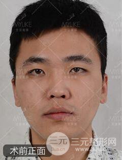 歐陽(yáng)春雙眼皮前后對(duì)比圖 男孩子割雙眼皮一樣好看