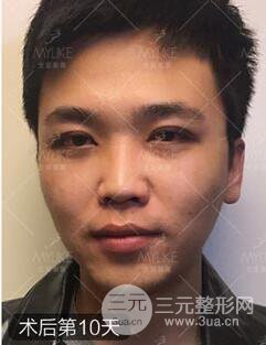 歐陽(yáng)春雙眼皮前后對(duì)比圖 男孩子割雙眼皮一樣好看