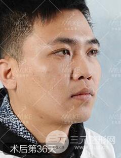 歐陽(yáng)春雙眼皮前后對(duì)比圖 男孩子割雙眼皮一樣好看