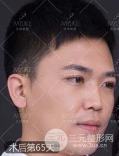 歐陽(yáng)春雙眼皮前后對(duì)比圖 男孩子割雙眼皮一樣好看