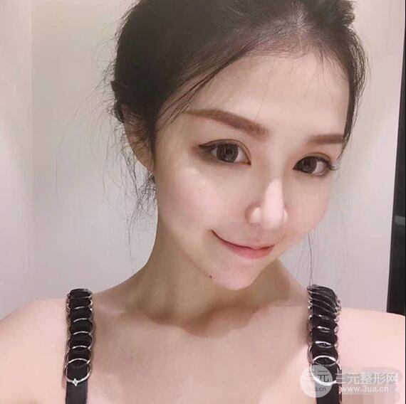 延吉金光善眼部整形失敗修復(fù)前后對比圖 三個月恢復(fù)自然