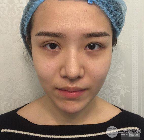 延吉金光善眼部整形失敗修復(fù)前后對比圖 三個月恢復(fù)自然