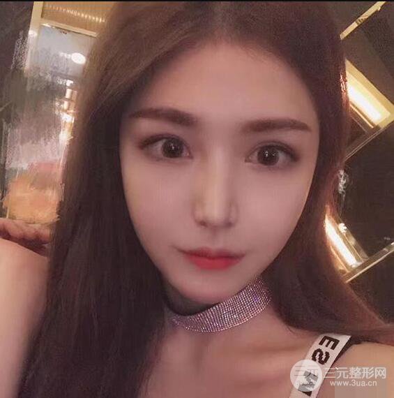 延吉金光善眼部整形失敗修復(fù)前后對比圖 三個月恢復(fù)自然