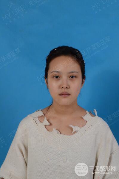 北京美萊趙峻賢隆鼻整形真實案例對比圖恢復過程分享