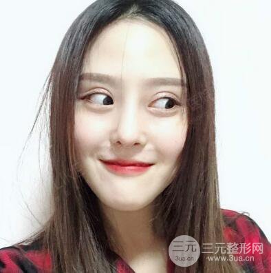 北京美萊趙峻賢隆鼻整形真實案例對比圖恢復過程分享