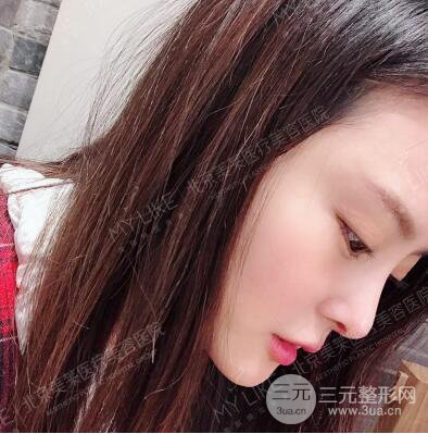 北京美萊趙峻賢隆鼻整形真實案例對比圖恢復過程分享