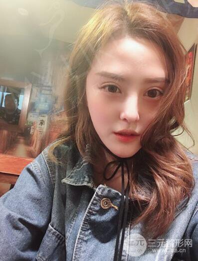 北京美萊趙峻賢隆鼻整形真實案例對比圖恢復過程分享
