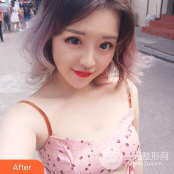 成都天使之翼張勁松切開雙眼皮案例前后對比圖心情小札