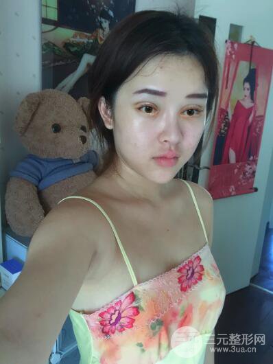 成都天使之翼張勁松切開雙眼皮案例前后對比圖心情小札