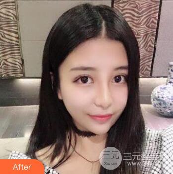 沈陽軍區(qū)總醫(yī)院時杰切開雙眼皮案例對比圖|內(nèi)附心情恢復(fù)小札哦