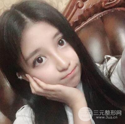 沈陽軍區(qū)總醫(yī)院時杰切開雙眼皮案例對比圖|內(nèi)附心情恢復(fù)小札哦