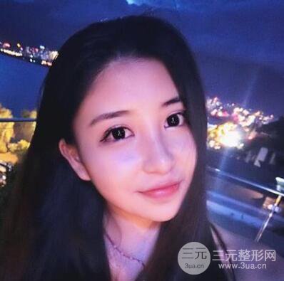 沈陽軍區(qū)總醫(yī)院時杰切開雙眼皮案例對比圖|內(nèi)附心情恢復(fù)小札哦